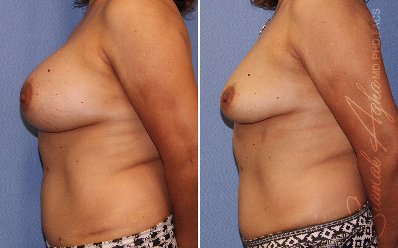 Breast Implant Removal Patient 02