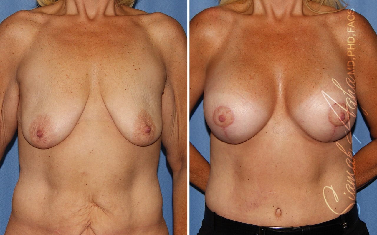 Orange County Breast Lift Patient 14 Front 3 Months Post Op Newport Beach, CA