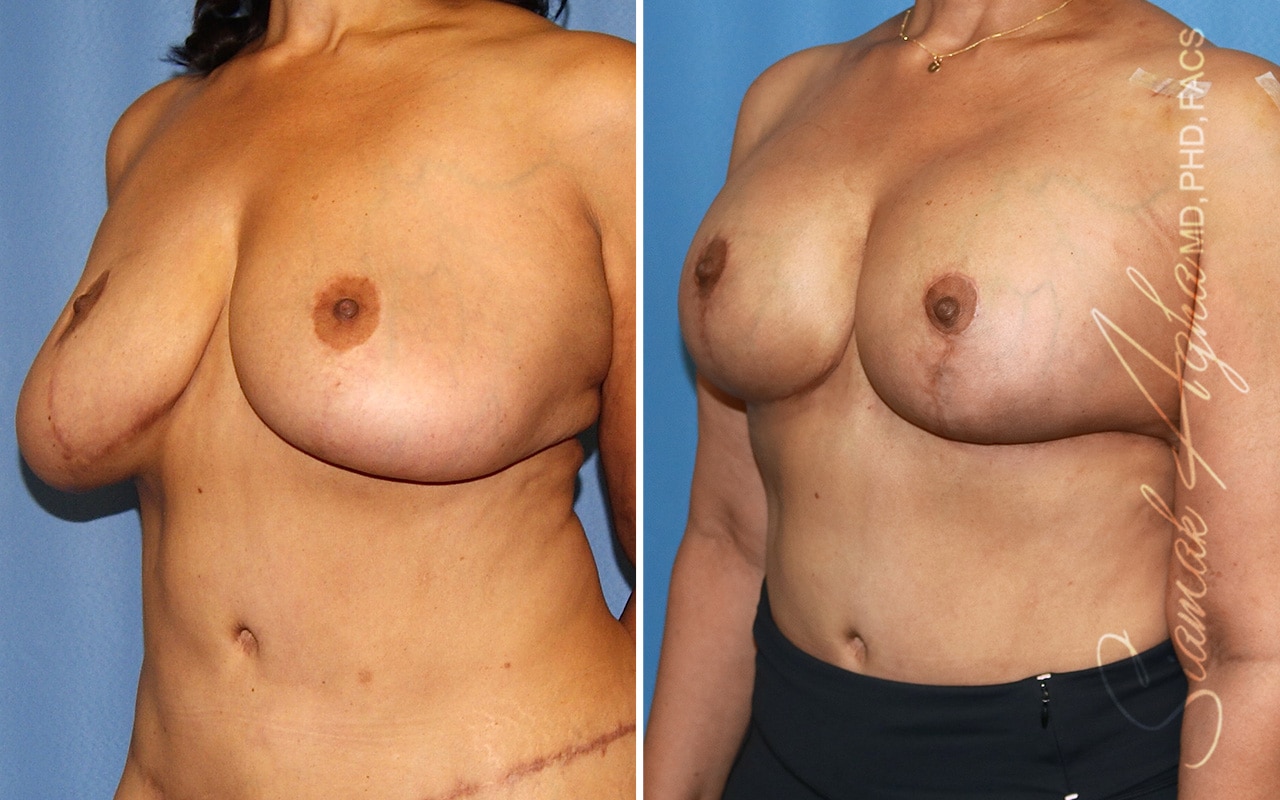 Orange County Breast Reduction Patient 8 Front Left Newport Beach, CA