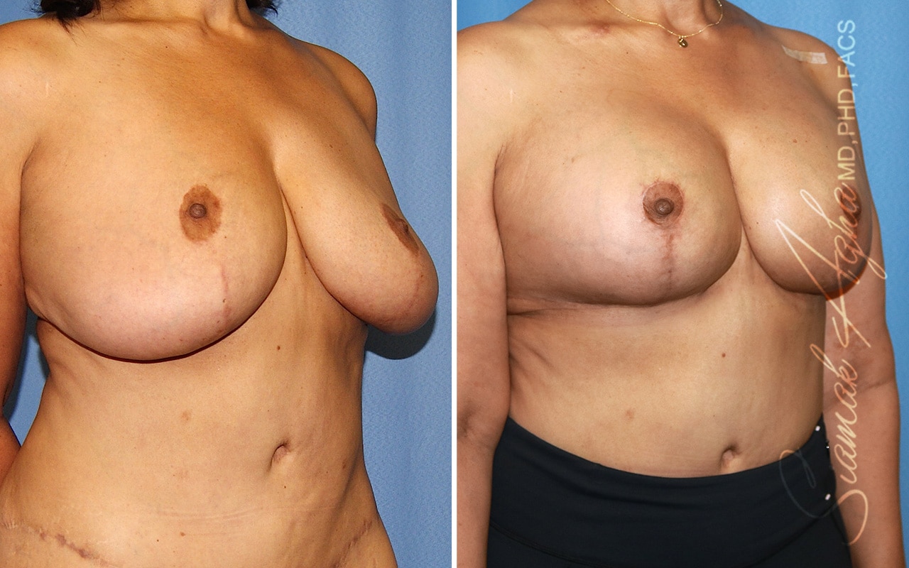 Orange County Breast Reduction Patient 8 Front Right Newport Beach, CA