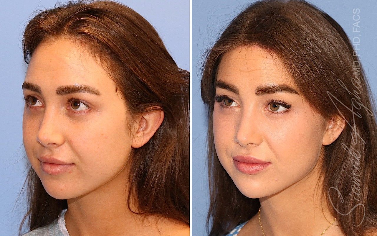 Orange County Forehead Reduction Patient 07 Front Left Newport Beach, CA