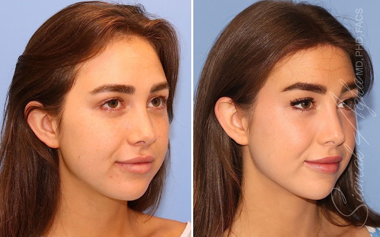 Orange County Forehead Reduction Patient 07 Front Right Newport Beach, CA