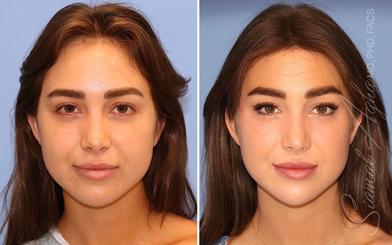 Orange County Forehead Reduction Patient 07 Front Newport Beach, CA