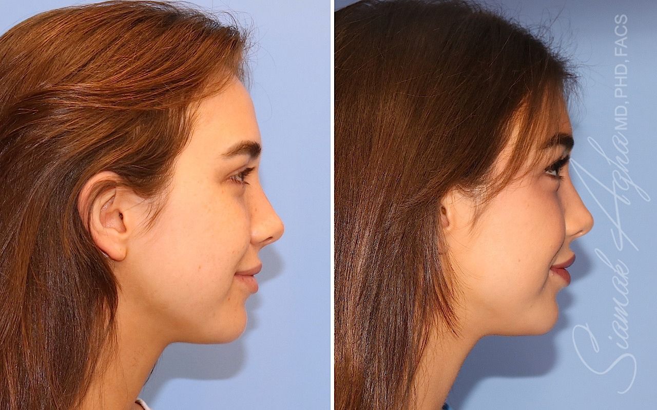 Orange County Forehead Reduction Patient 07 Right Newport Beach, CA