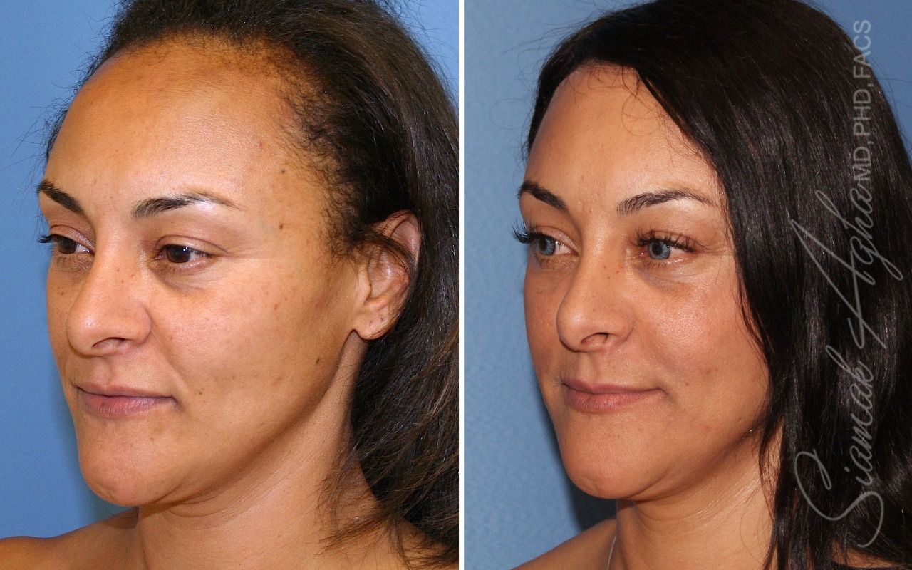 Orange County Forehead Reduction Patient 08 Front Left Newport Beach, CA