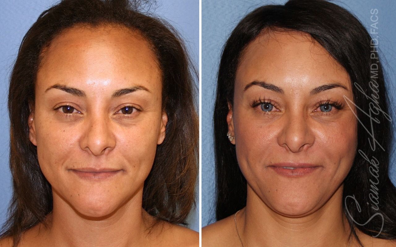 Orange County Forehead Reduction Patient 08 Front Newport Beach, CA
