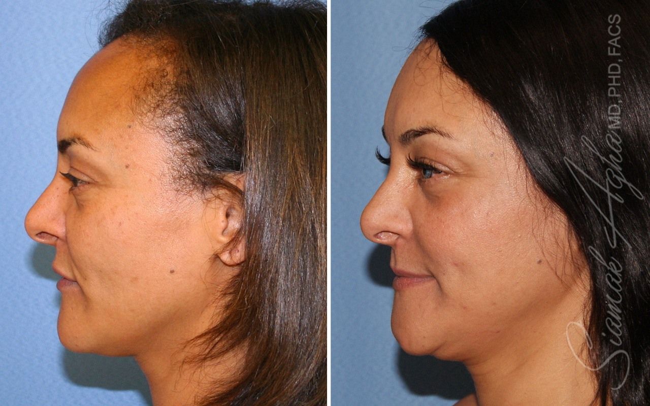 Orange County Forehead Reduction Patient 08 Left Newport Beach, CA