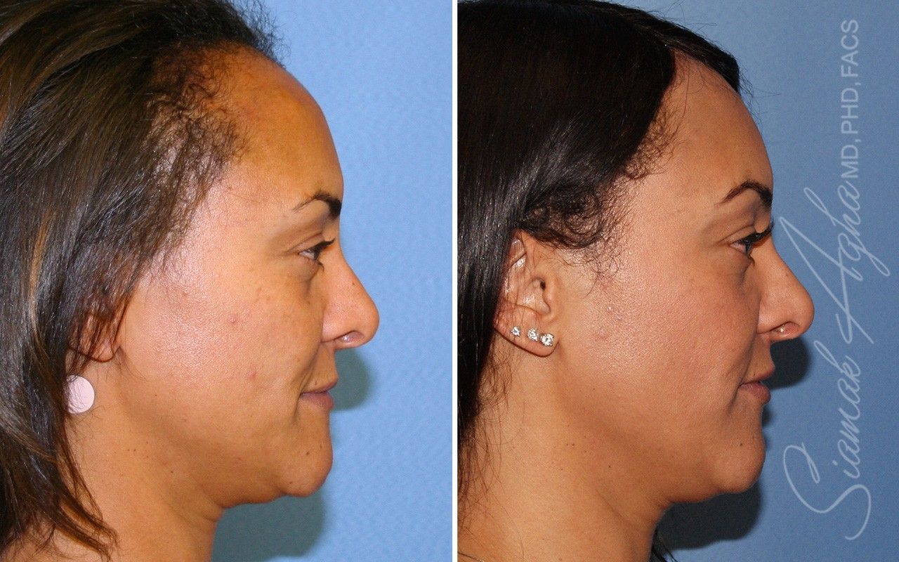Orange County Forehead Reduction Patient 08 Right Newport Beach, CA