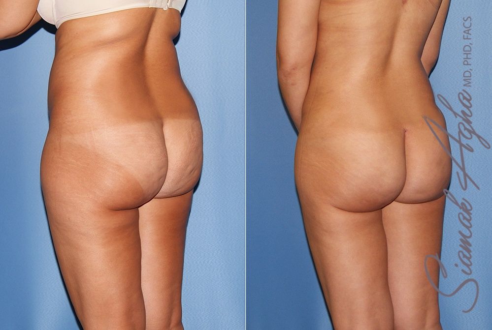 Liposuction Patient 25