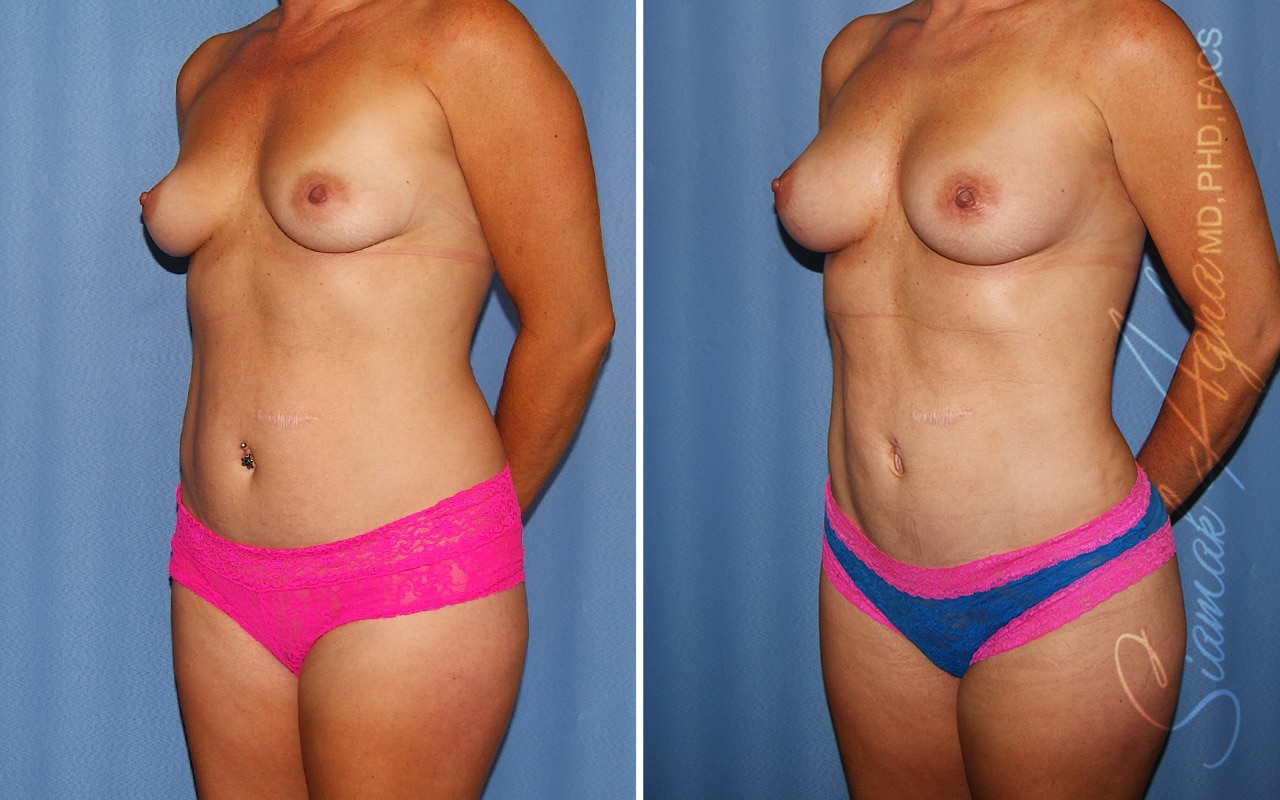Liposuction Patient 28