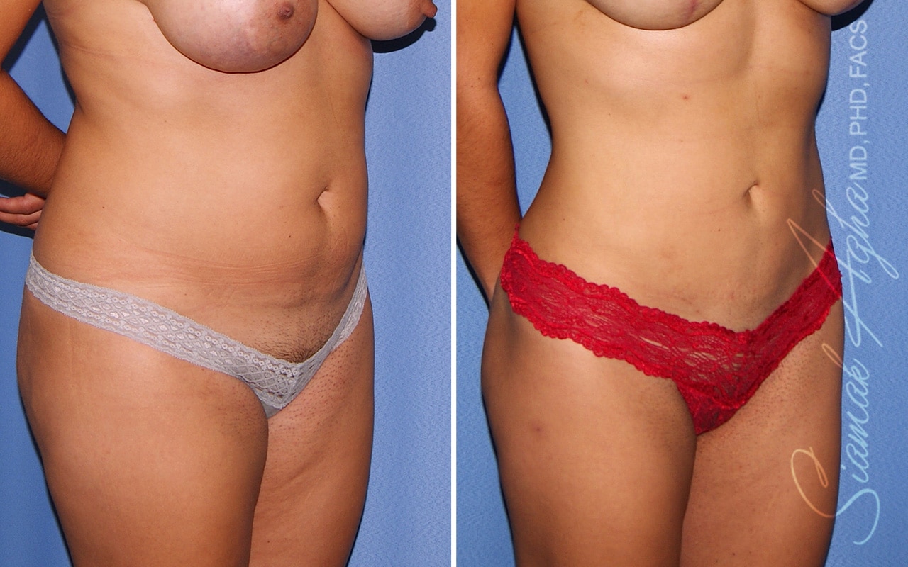 Liposuction Patient 29