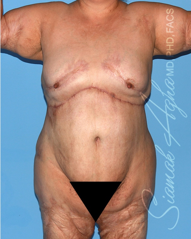 Reverse Abdominoplasty