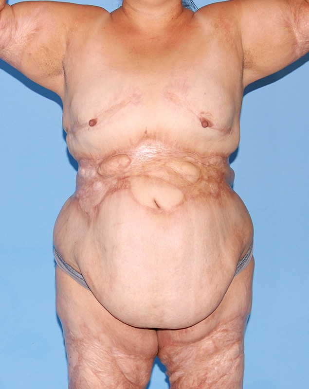 Tummy Tuck Revision Surgery Before & After Photo Gallery - Patient #1