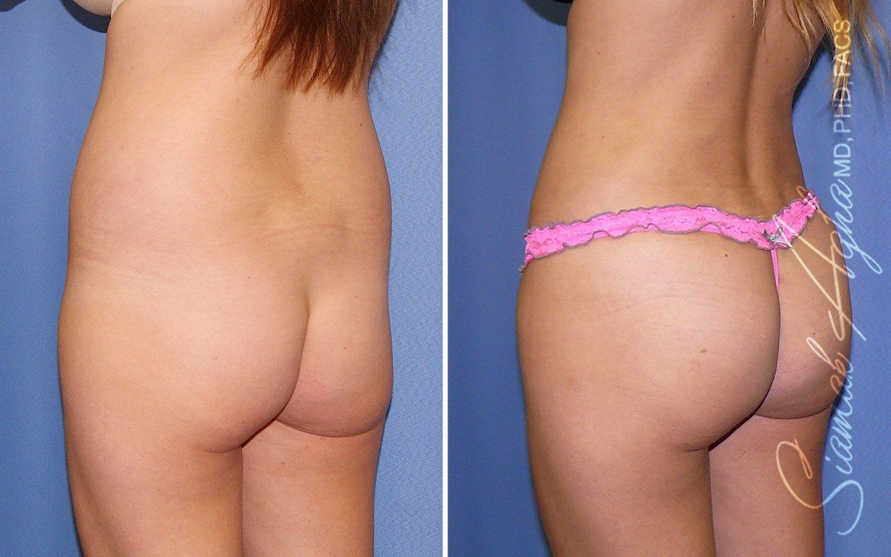 Combined Tummy Tuck and Brazilian Butt Lift Patient 100