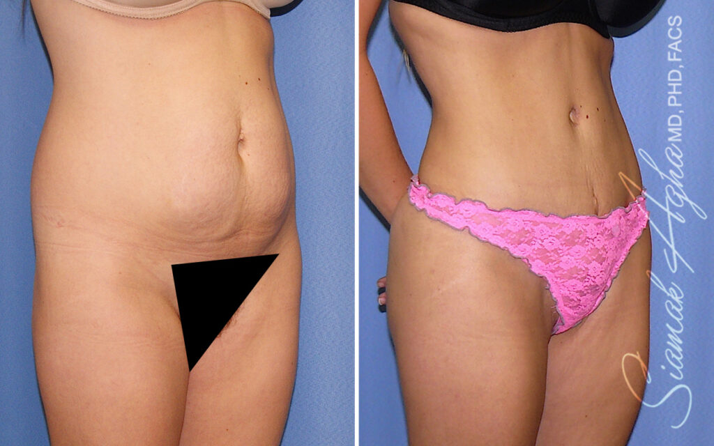 Orange County Tummy Tuck Patient 100 Front Right Newport Beach, CA
