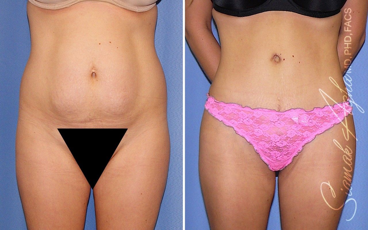 Combined Tummy Tuck and Brazilian Butt Lift Patient 100
