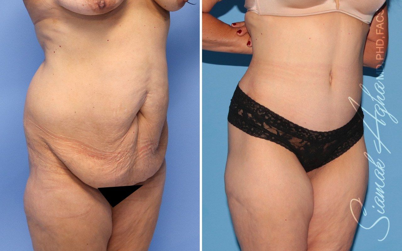 Combined Tummy Tuck and Brazilian Butt Lift Patient 102