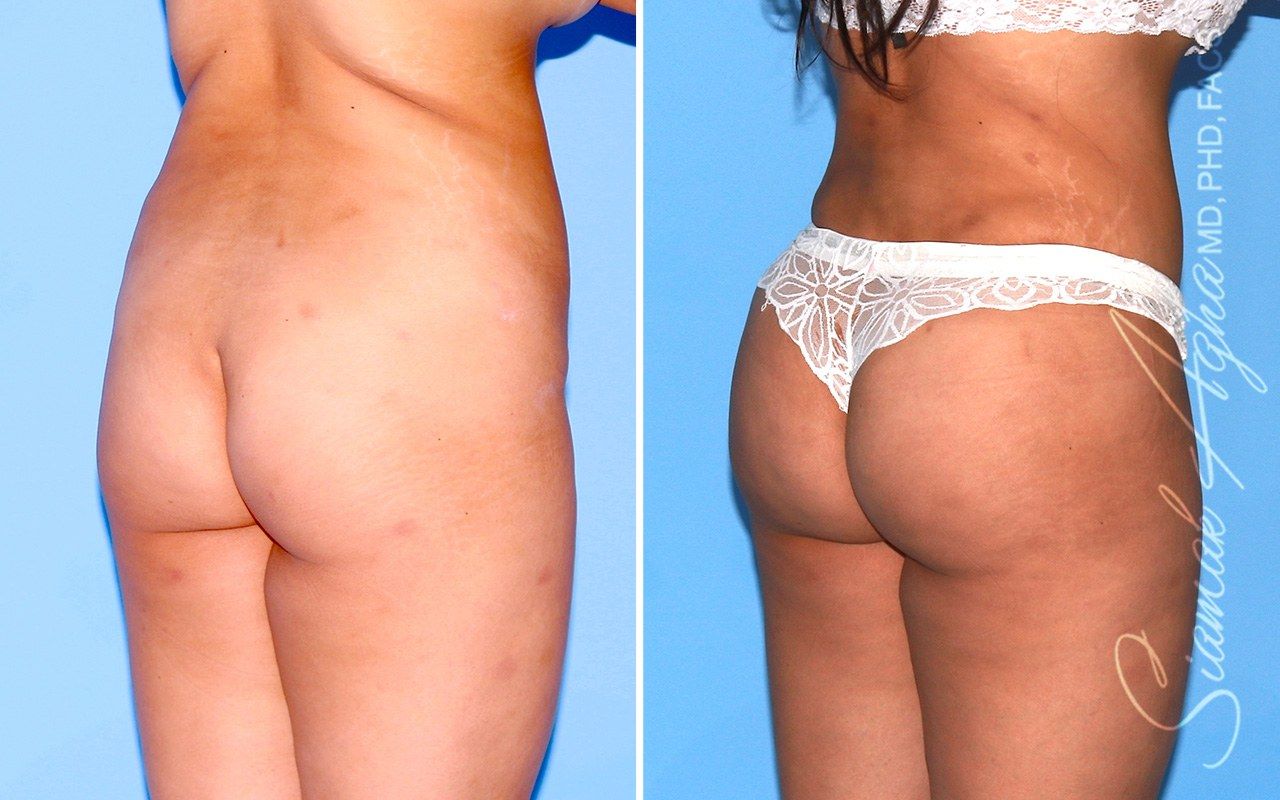 Combined Tummy Tuck and Brazilian Butt Lift Patient 104