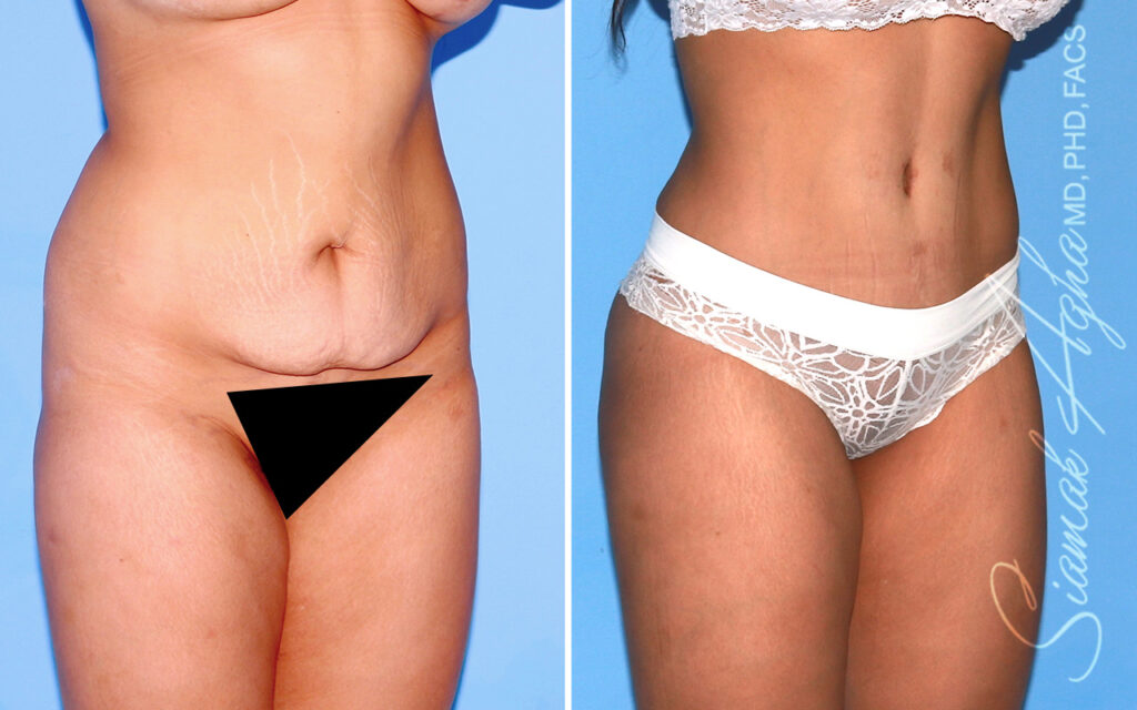 Orange County Tummy Tuck Patient 104 Front Right Newport Beach, CA