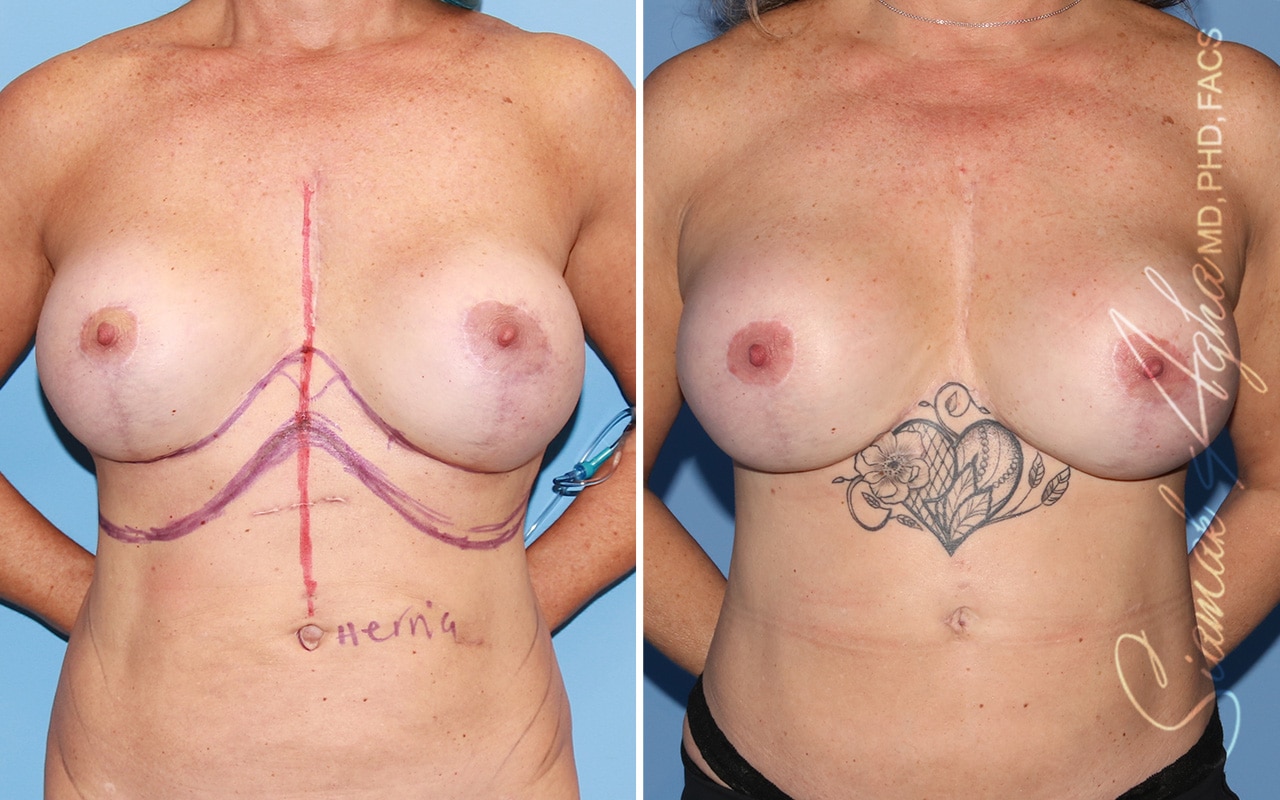 Reverse Tummy Tuck Before & After - With Pl