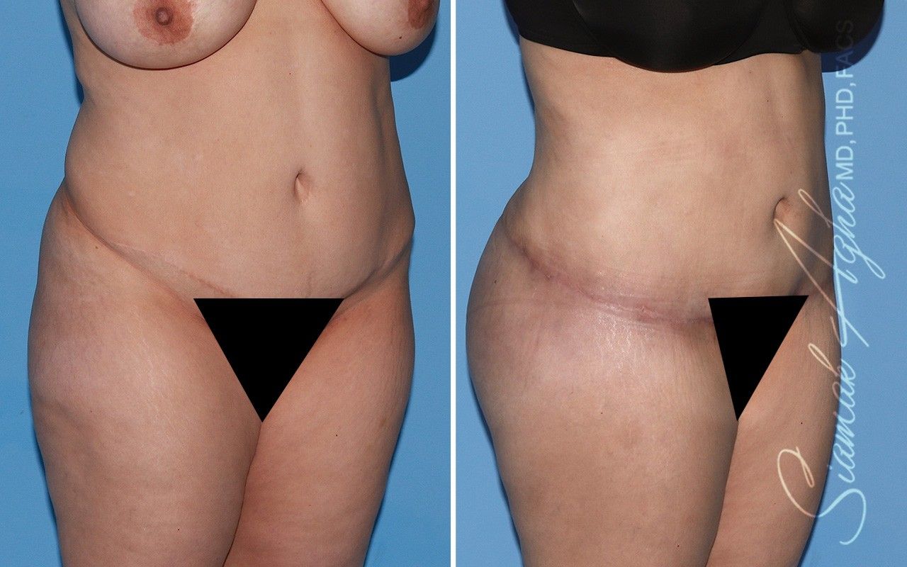 Combined Tummy Tuck and Brazilian Butt Lift Patient 76