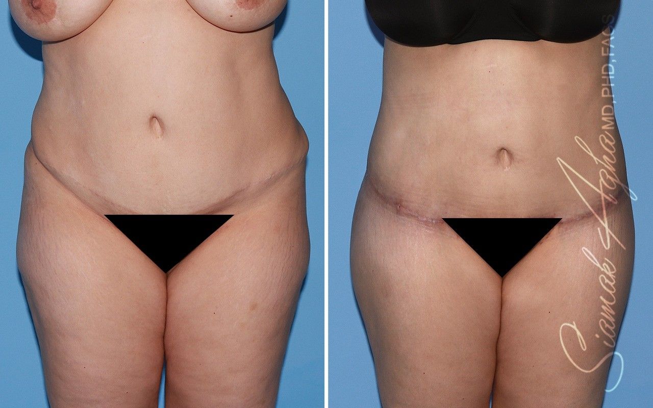 Combined Tummy Tuck and Brazilian Butt Lift Patient 76