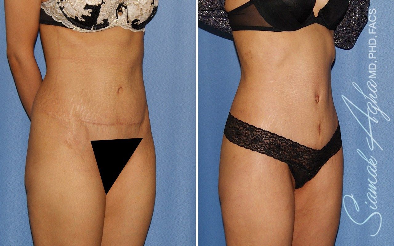 Combined Tummy Tuck and Brazilian Butt Lift Patient 97
