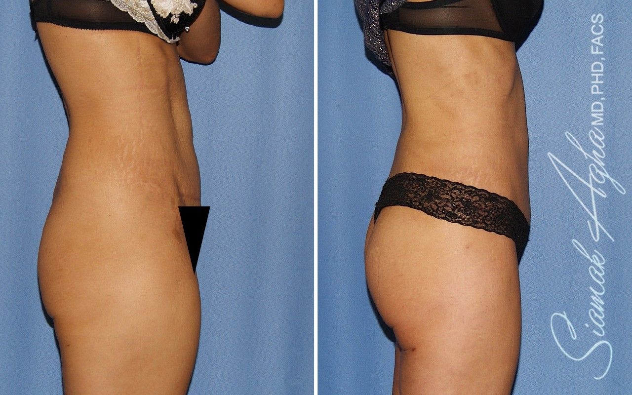Combined Tummy Tuck and Brazilian Butt Lift Patient 97