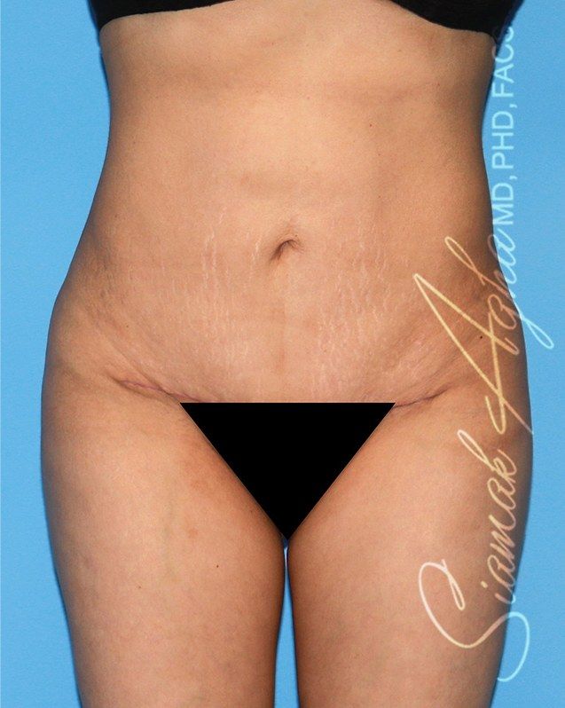 Mini Tuck And Tummy Tuck (abdominoplasty) Before & After Photos Patient 06