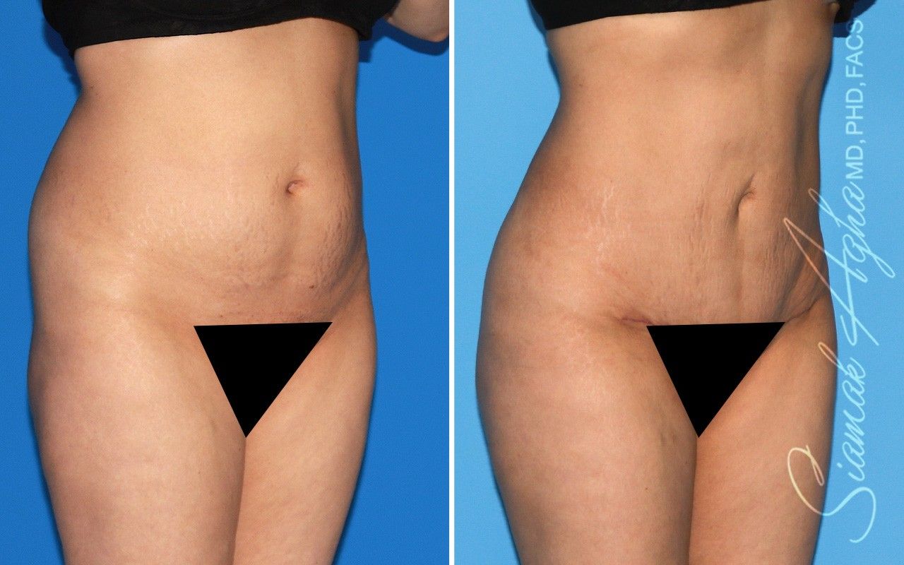 Combined Tummy Tuck and Brazilian Butt Lift Patient 98
