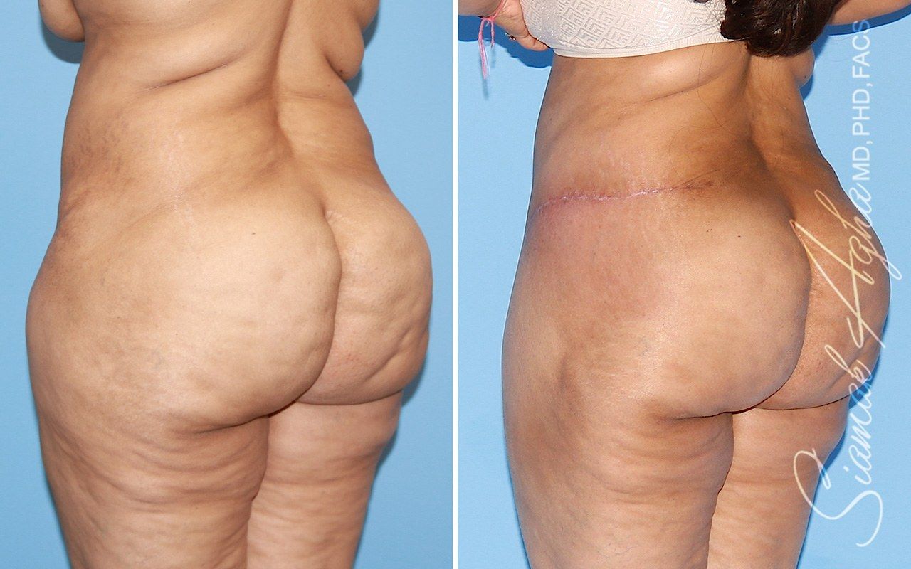 Orange county tummy tuck with thigh lift patient 01 back left | Newport Beach, CA