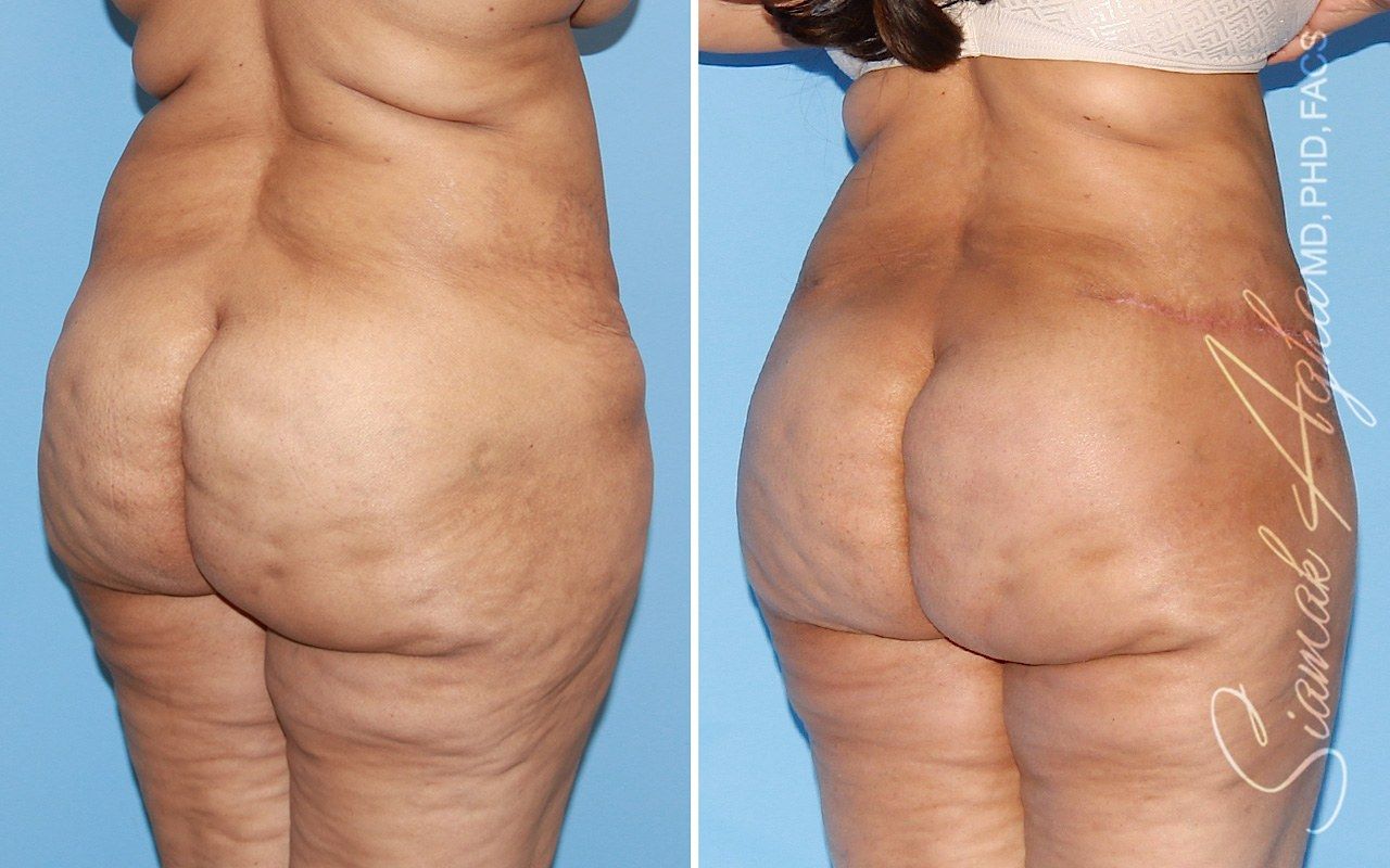Orange county tummy tuck with thigh lift patient 01 back right | Newport Beach, CA