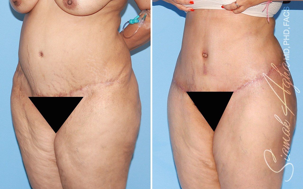 Orange county tummy tuck with thigh lift patient 01 front left | Newport Beach, CA