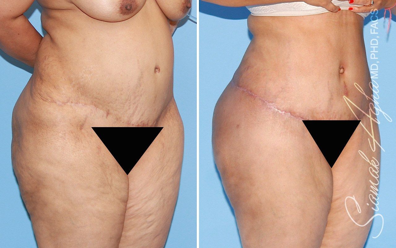 Orange county tummy tuck with thigh lift patient 01 front right | Newport Beach, CA