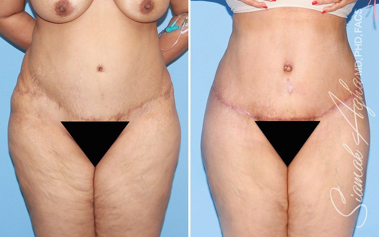 Orange county tummy tuck with thigh lift patient 01 front | Newport Beach, CA