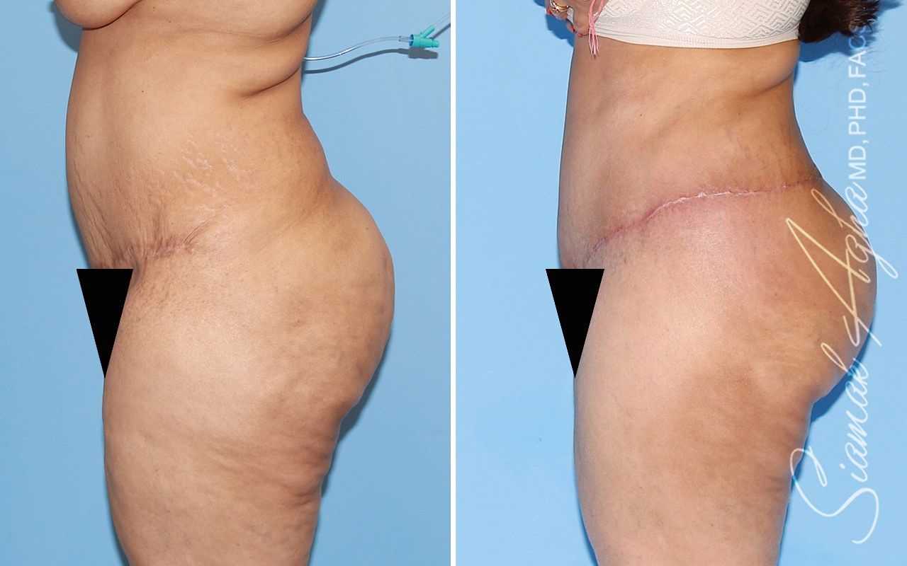 Orange county tummy tuck with thigh lift patient 01 left | Newport Beach, CA