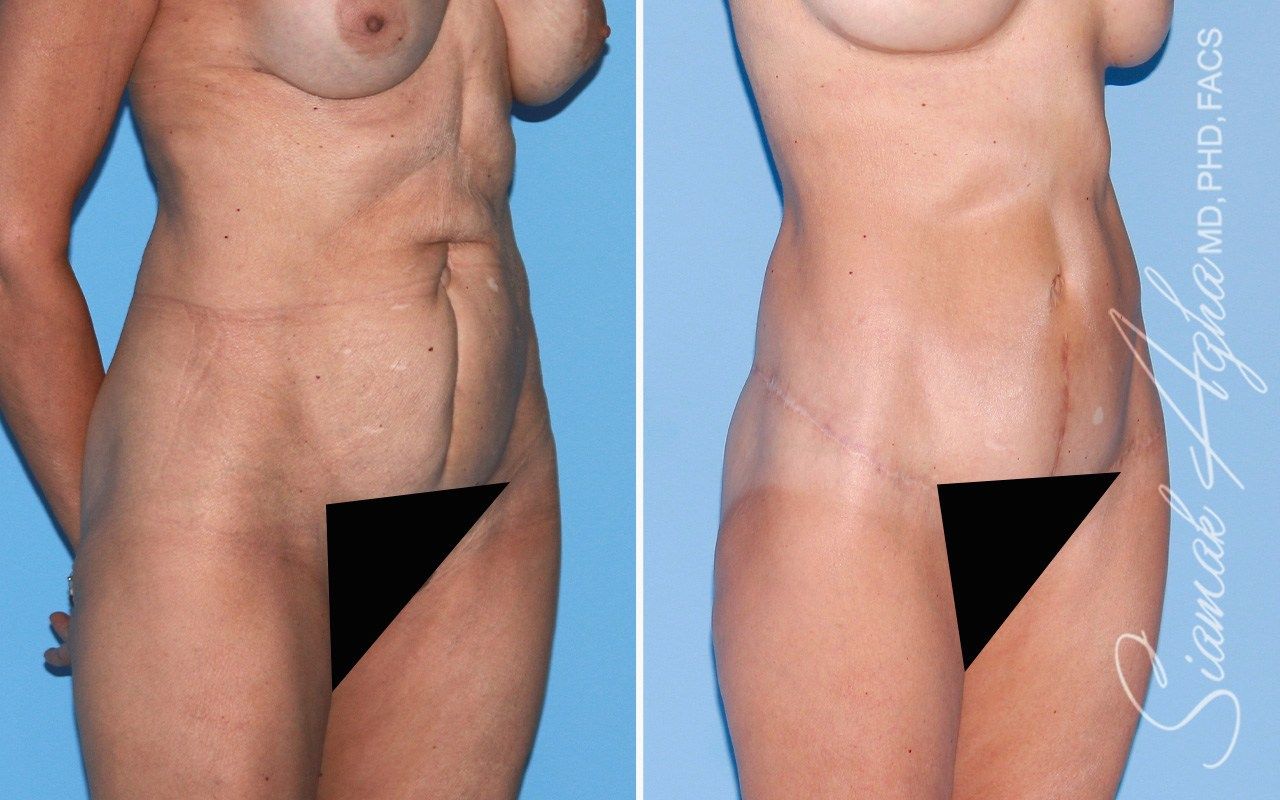 Tummy Tuck with Thigh Lift Patient 2