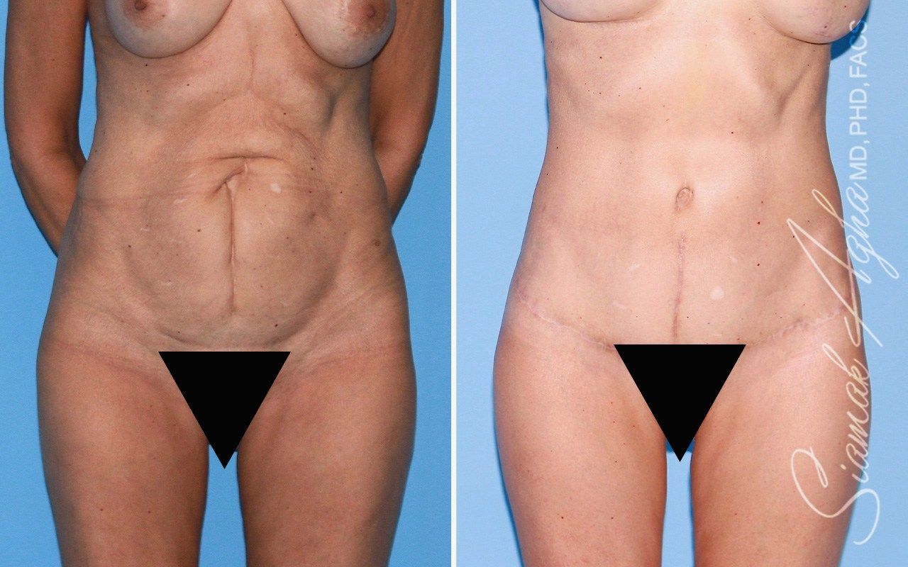Tummy Tuck With Thigh Lift