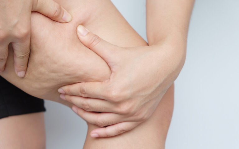 What Causes Cellulite & How is It Treated?
