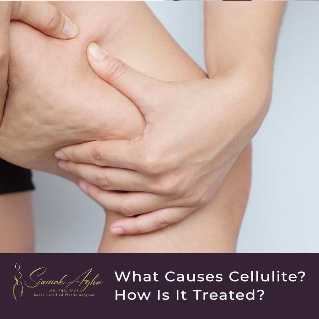 What causes Cellulite and how is it treated? Instagram Post 
