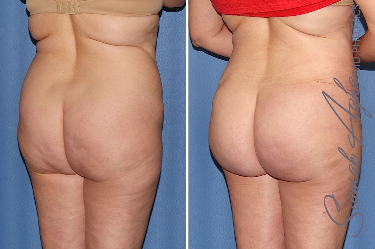 Combined tummy tuck brazilian butt lift patient 32 back right | Newport Beach, CA