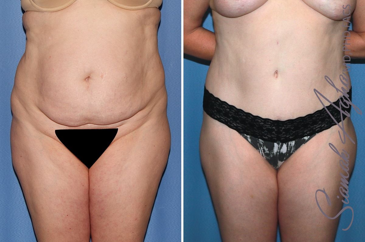 Combined Tummy Tuck and Brazilian Butt Lift Patient 32