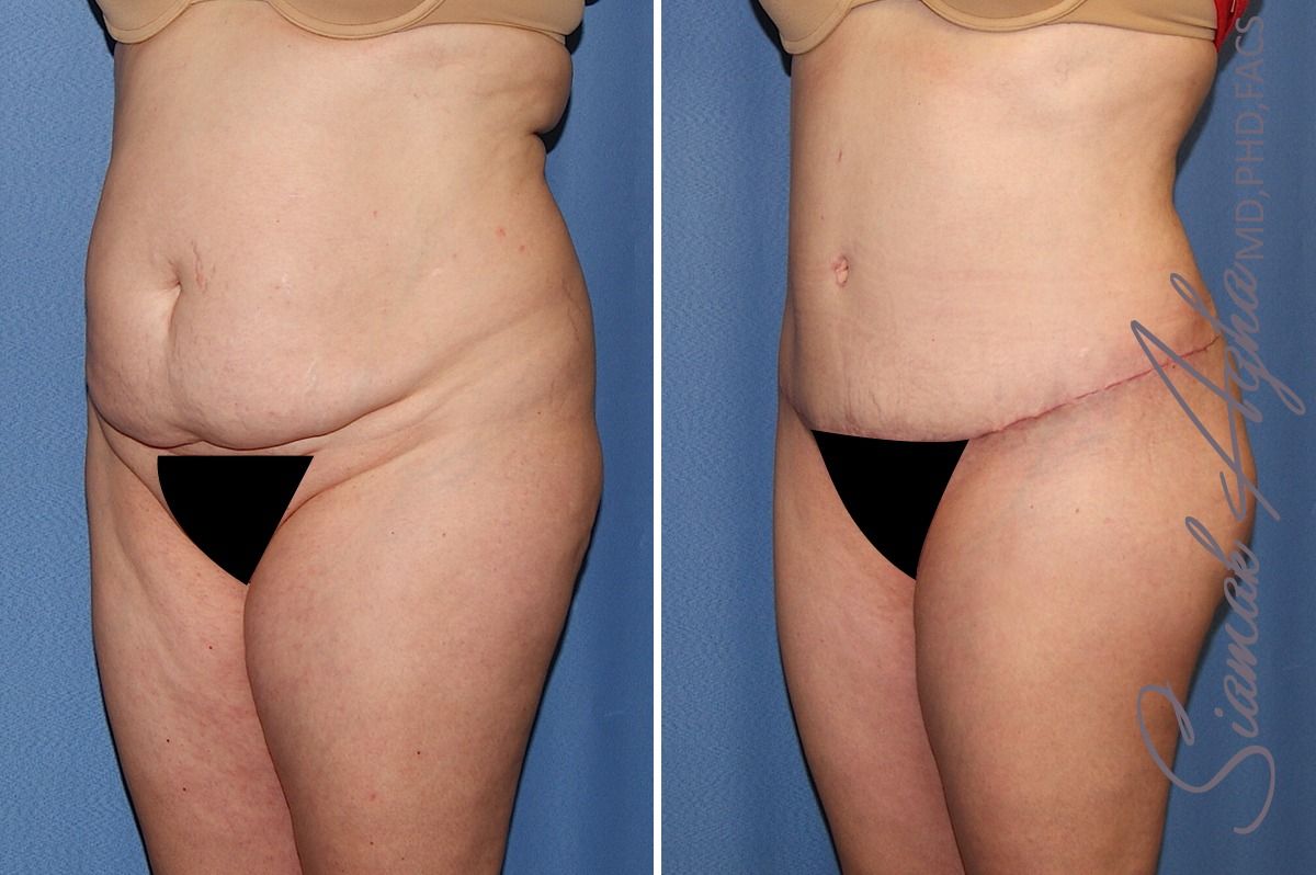 Combined Tummy Tuck and Brazilian Butt Lift Patient 32