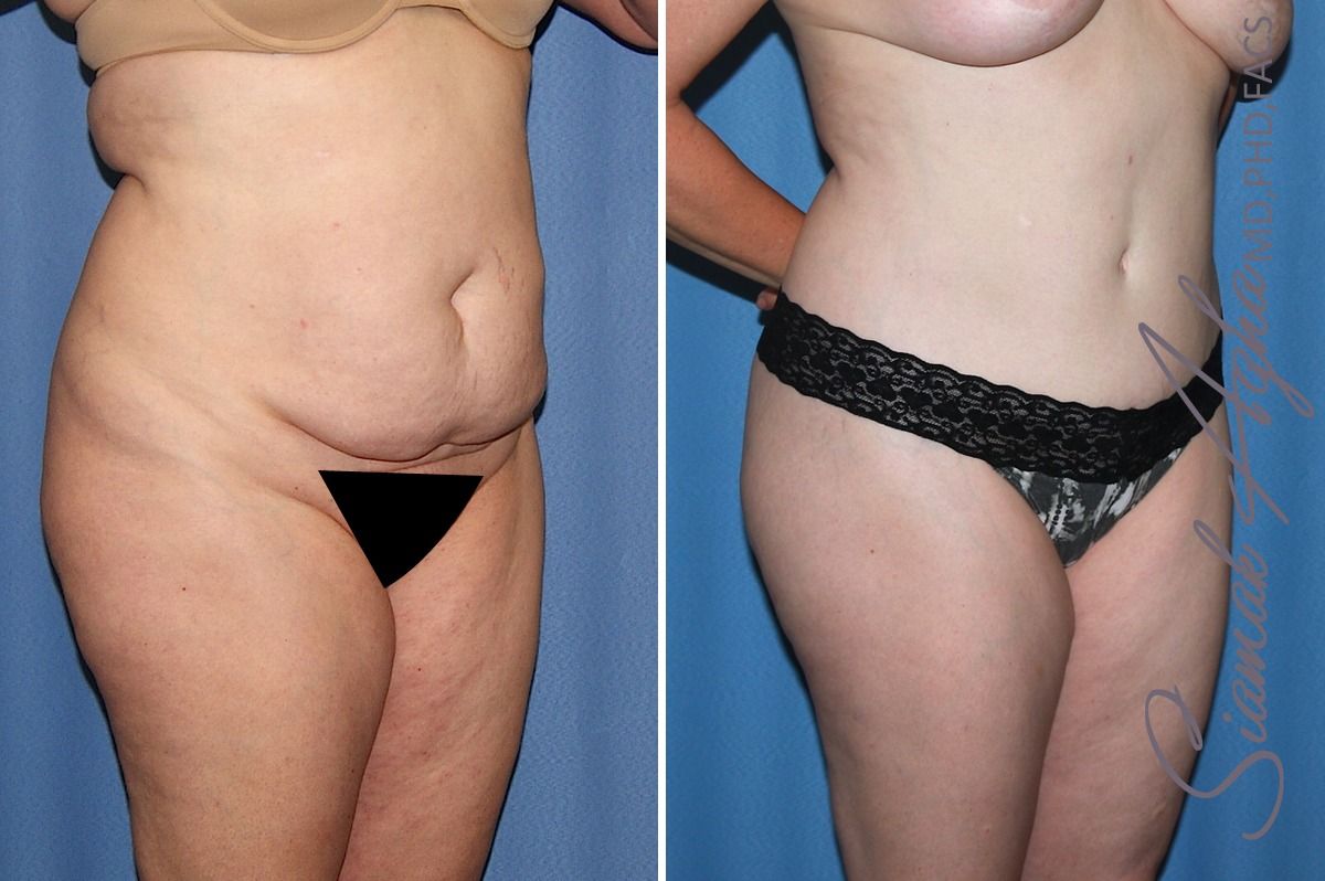 Combined tummy tuck brazilian butt lift patient 32 years front rigth | Newport Beach, CA