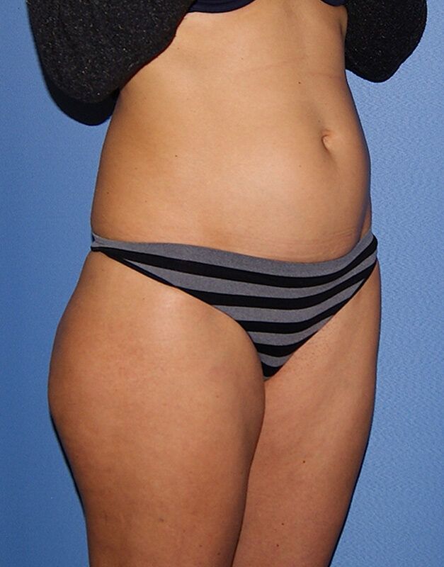 How can I expect my belly to look after a tummy tuck? - Dr. Ali