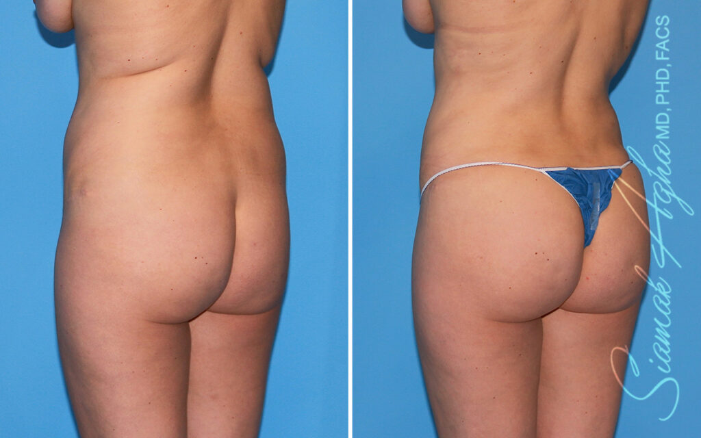 Orange county brazilian butt lift patient 65 Back Left Newport Beach, CA