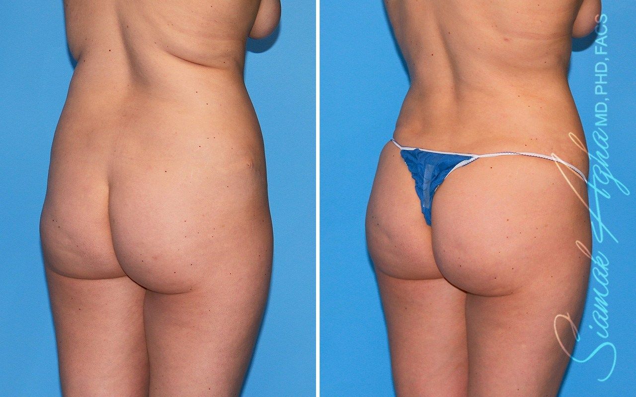 Combined Tummy Tuck and Brazilian Butt Lift Patient 101