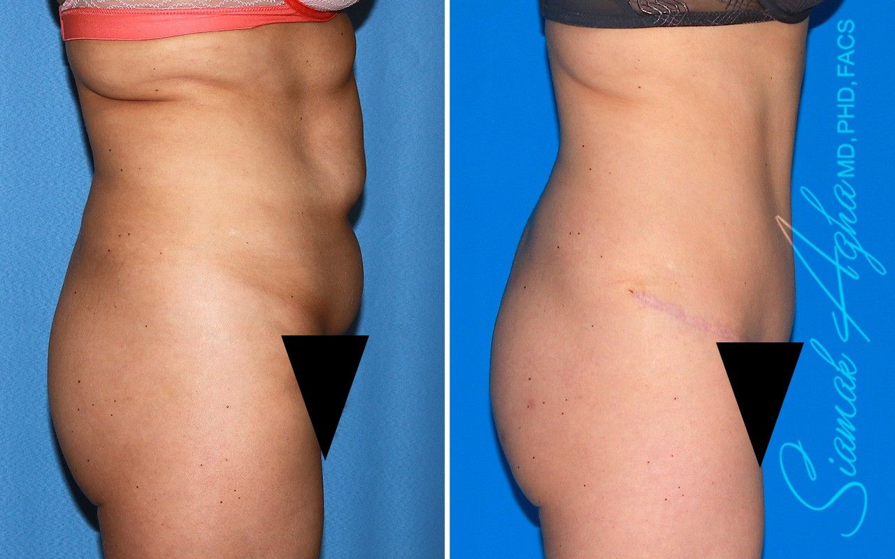 Combined Tummy Tuck and Brazilian Butt Lift Patient 101