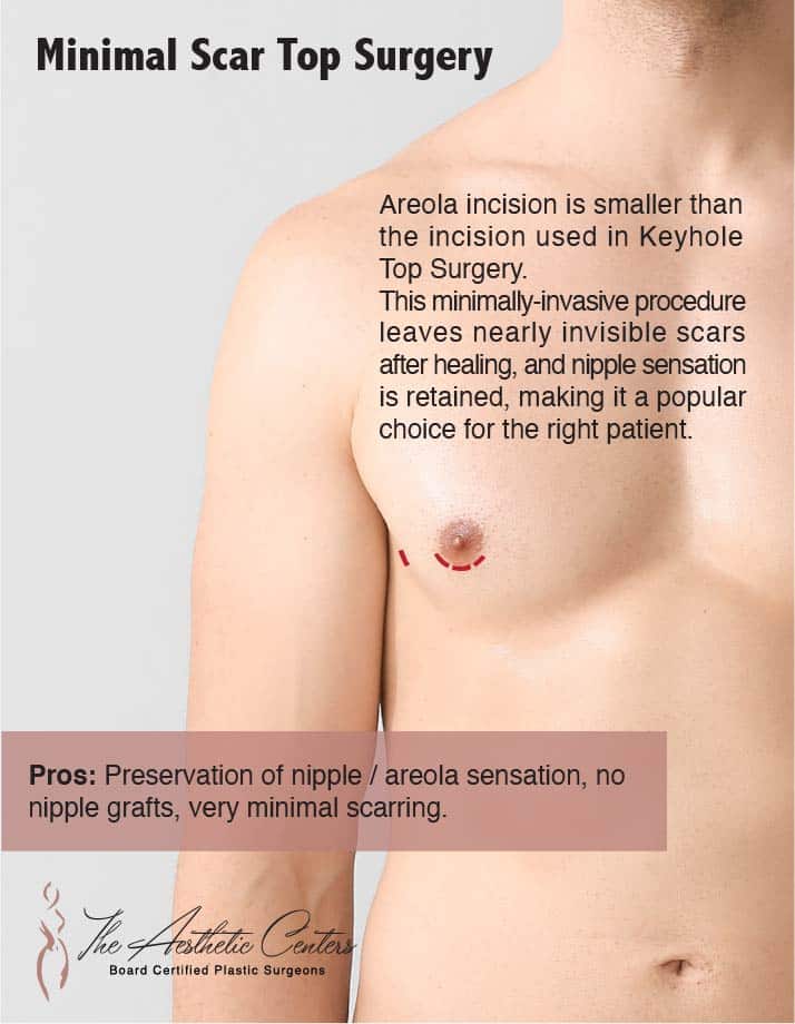 How To Get Rid Of Puffy Nipples Or Type 1 Gynecomastia?