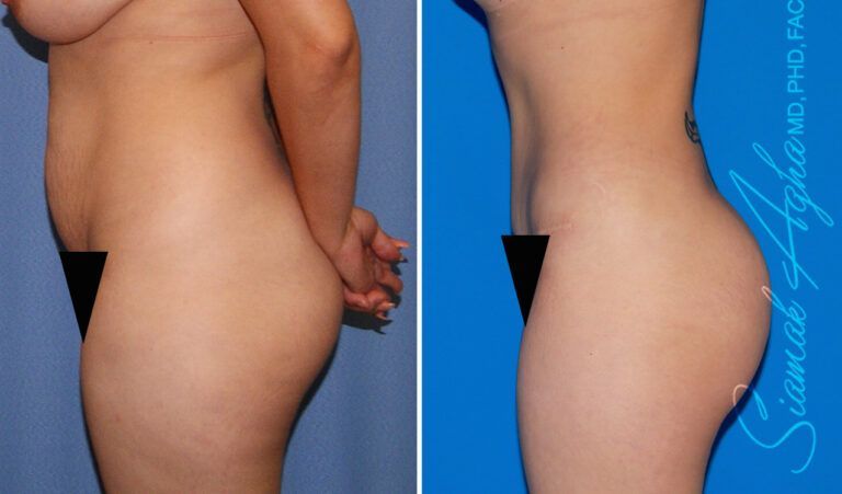 Combined Tummy Tuck and Brazilian Butt Lift Patient 99